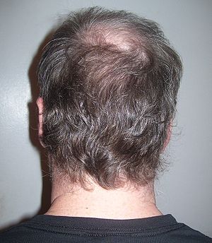 MALE PATTERN BALDNESS AND IT'S TREATMENT - Body4Real